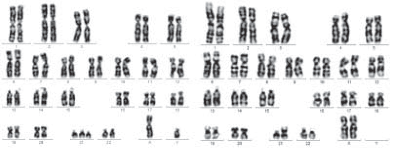 Karyotype showing trisomy 21 (47,XY,+21 or 47,XX,+21) compared to normal chromosome complement