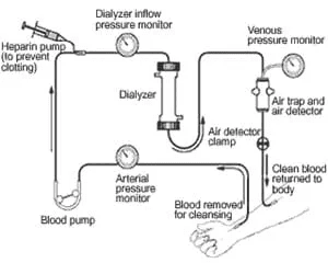 Hemodialysis machine setup showing blood flow and dialysis fluid