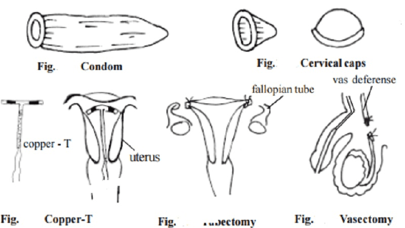 विभिन्न अवरोधक गर्भनिरोधक उपकरणों का labeled diagram