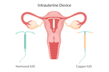 Copper-T के गर्भाशय में स्थापना और कार्यप्रणाली का diagram